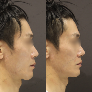 新宿の鼻翼基部ヒアルロン酸｜40代男性がボリューマで得た効果と費用の症例写真
