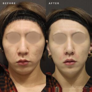 新宿のほうれい線ヒアルロン酸（ダイヤモンドフィール/ピネハ）｜30代男性の効果と料金の症例写真