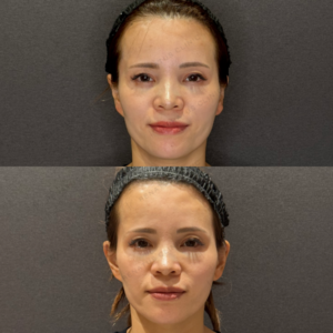 名古屋で立ち耳をヒアルロン酸で改善｜40代のボリューマ（VOLUMA）症例の症例写真