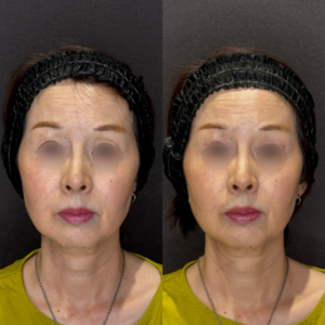 名古屋で目の上ヒアルロン酸｜60代女性がボルベラで若返り効果を実感の症例写真