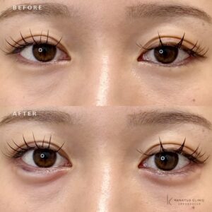 福岡天神で涙袋ヒアルロン酸｜ボルベラで自然なふっくら感を叶えた20代女性の効果と料金の症例写真