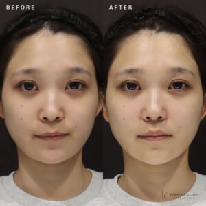 新宿で鼻翼基部ヒアルロン酸｜ボリューマで自然な小鼻を叶えた20代女性の効果と料金の症例写真