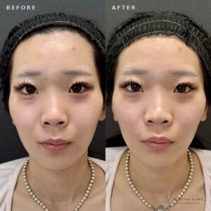 福岡天神でほうれい線ヒアルロン酸｜ボリフト効果と料金相場【20代女性】の症例写真