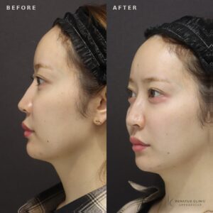 新宿で涙袋ヒアルロン酸が上手いクリニック｜ボルベラ使用・30代女性の自然な仕上がりの症例写真