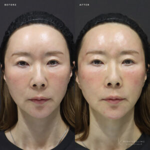新宿でマリオネットラインヒアルロン酸｜ボリフト使用・40代女性の効果と料金相場の症例写真