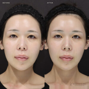 新宿で鼻ヒアルロン酸におすすめのボラックス（VOLUX）｜20代女性の仕上がりと費用の症例写真