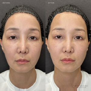 大阪梅田でヒアルロン酸が上手いクリニック｜目の上ボルベラの効果・料金を40代女性が解説の症例写真