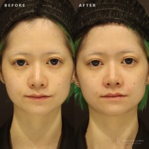 新宿で眉上ヒアルロン酸の効果と料金相場｜30代女性がボラックス（VOLUX）を体験の症例写真