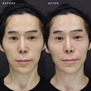 新宿で鼻翼基部ヒアルロン酸｜ボリューマで40代男性の小鼻を自然に整えるおすすめ施術の症例写真