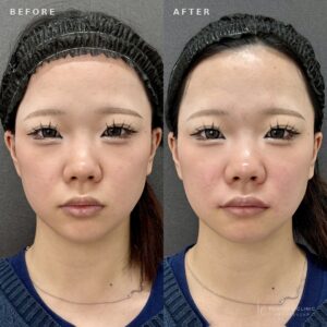 福岡天神のヒアルロン酸唇整形｜ボルベラで叶える自然な厚みと形【20代女性】の症例写真