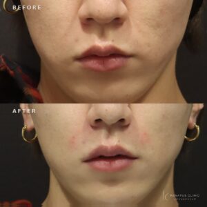 新宿でほうれい線ヒアルロン酸が上手いクリニック｜ダイヤモンドフィール・30代男性の効果と料金の症例写真