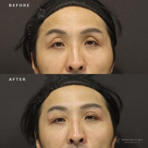新宿のヒアルロン酸目の上｜40代男性がボルベラで実感した効果と料金相場の症例写真