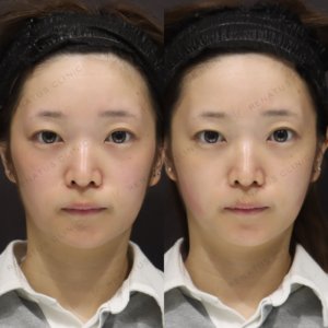 新宿でヒアルロン酸（ボリフト）頬に入れるなら｜20代女性の効果と料金相場の症例写真