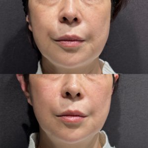 東京田町でヒアルロン酸リフトアップ｜60代女性がボリューマで実感した効果と費用の症例写真