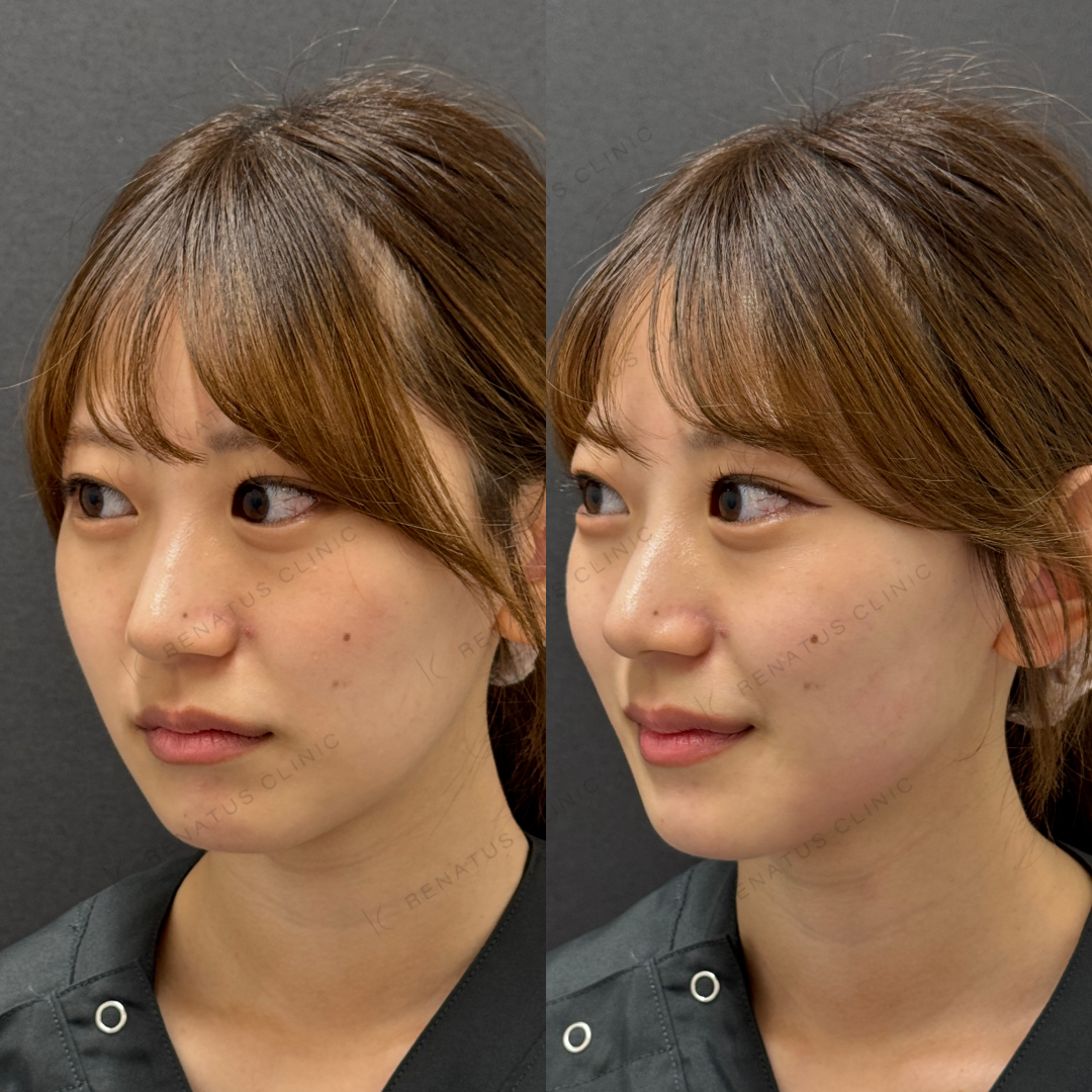 ザーフ(XERF)とは?効果・値段・何回で効果が出るか 17 ザーフ症例写真 斜め(照射前・照射後)