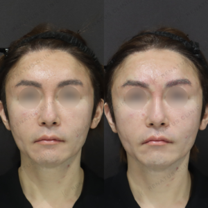 新宿の眉上ヒアルロン酸｜40代男性がボラックスで叶えた立体感と持続効果の症例写真