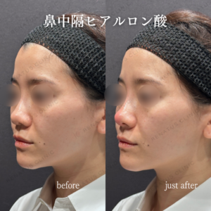 東京田町で鼻ヒアルロン酸の効果と費用｜20代女性がボラックスで高鼻梁を実現の症例写真