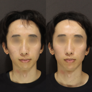 新宿で顎ヒアルロン酸が上手いクリニック｜ダイヤモンドフィール使用・20代男性のEラインを自然に整えた症例の症例写真