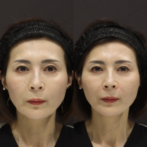 新宿でヒアルロン酸注射｜50代女性のほうれい線・目の上にボルベラで若返り効果の症例写真