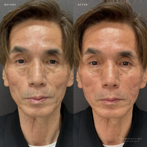 福岡天神のヒアルロン酸でゴルゴライン・頬改善｜ボリフト60代男性の効果と料金の症例写真