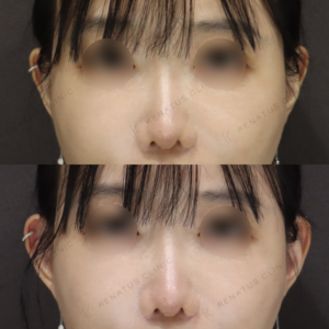 新宿の立ち耳ヒアルロン酸｜ボルベラで自然に改善した30代女性の効果と料金の症例写真