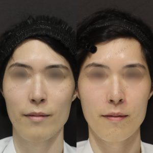 新宿でヒアルロン酸ほうれい線治療｜30代男性がボリフトで得た効果と料金の症例写真