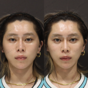 新宿ゴルゴラインヒアルロン酸｜20代男性がボリフトで得た自然な若返り効果と料金の症例写真