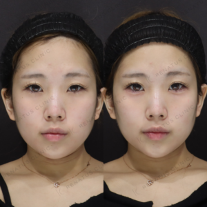新宿の涙袋ヒアルロン酸｜ボルベラで自然なふっくら涙袋を叶えた20代女性の効果と料金の症例写真