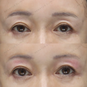 新宿でヒアルロン酸・目の上のくぼみ治療｜ボルベラで50代女性が実感した効果と料金の症例写真