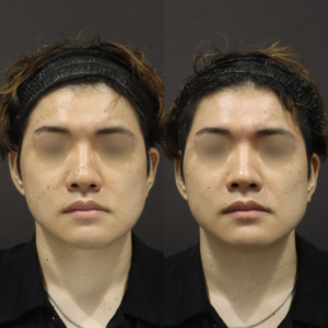 新宿で鼻ヒアルロン酸が上手いクリニック｜ボラックス使用・30代男性の高さ・形を整えた症例の症例写真
