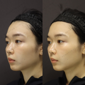 新宿で鼻翼基部ヒアルロン酸｜ボリューマで小鼻を自然に整えた20代女性の効果と料金の症例写真
