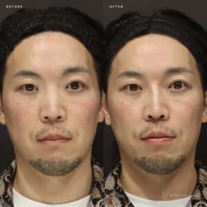 新宿のヒアルロン酸で鼻・ほうれい線を自然に若返り｜40代男性がボリフトで選ぶ名医と効果の症例写真