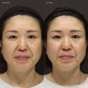 新宿でほうれい線ヒアルロン酸ボリフトの効果と料金｜50代女性のリアルな記録の症例写真