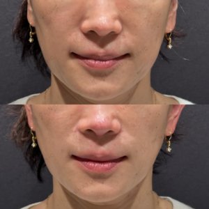 東京田町で鼻翼基部ヒアルロン酸｜40代女性がボリフトで選ぶ名医とはの症例写真