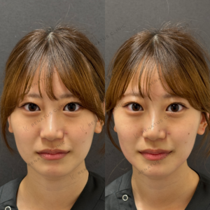 福岡天神のザーフ(XERF)で口角・フェイスラインを引き締め｜20代女性の効果と料金の症例写真