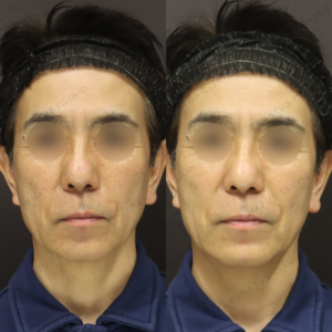 新宿で顎ヒアルロン酸が上手いクリニック｜ボラックスで60代男性の輪郭を整えた症例の症例写真
