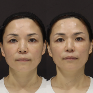 新宿でほうれい線ヒアルロン酸が上手いクリニック｜ダイヤモンドフィール使用・40代女性の自然な若返りの症例写真