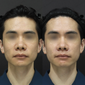 新宿でほうれい線ヒアルロン酸が上手い！30代男性がボリフトで選ぶ理由と効果・料金の症例写真