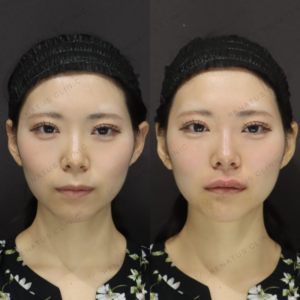 新宿で唇ヒアルロン酸が上手いクリニック｜20代女性がボルベラで自然な厚みを実現の症例写真