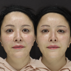 新宿で目の上のヒアルロン酸｜40代女性がボルベラで若返り効果を実感の症例写真
