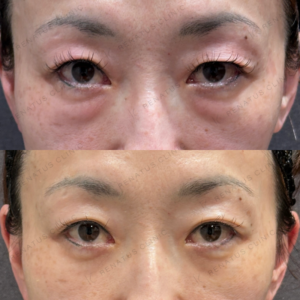 東京田町で目の下のクマ取り｜40代女性がヒアルロン酸で若返り効果と費用を解説の症例写真