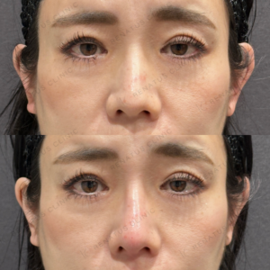 東京田町の鼻ヒアルロン酸｜40代女性がボラックスで叶える自然な高さと効果の症例写真