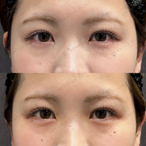 東京田町で涙袋ヒアルロン酸｜20代女性がボルベラで自然な涙袋を叶えた効果と料金相場の症例写真