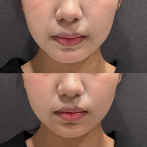 東京田町の顎ヒアルロン酸｜10代女性がボラックスで叶えるEラインの効果と費用の症例写真