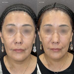 大阪梅田のゴルゴラインヒアルロン酸｜50代女性がボリューマで実感した効果と費用の症例写真