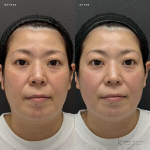 福岡天神で40代女性がザーフ(XERF)たるみ引き締め・フェイスライン改善を体験の症例写真