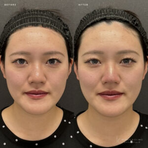 福岡天神のヒアルロン酸鼻整形｜ボラックスで自然な高さを叶えた20代女性の症例の症例写真
