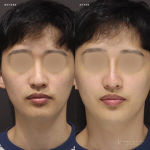 新宿のヒアルロン酸鼻整形｜20代男性がボラックスで叶えたシャープな鼻筋の効果と料金の症例写真