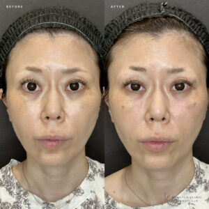 大阪梅田のヒアルロン酸で目の上をふっくら｜ボルベラで自然な若返り【30代女性】の症例写真