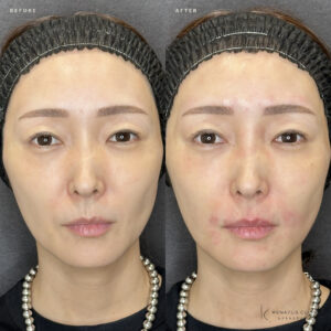 大阪梅田のほうれい線・口角ヒアルロン酸｜ボリフト効果と料金相場【40代女性】の症例写真